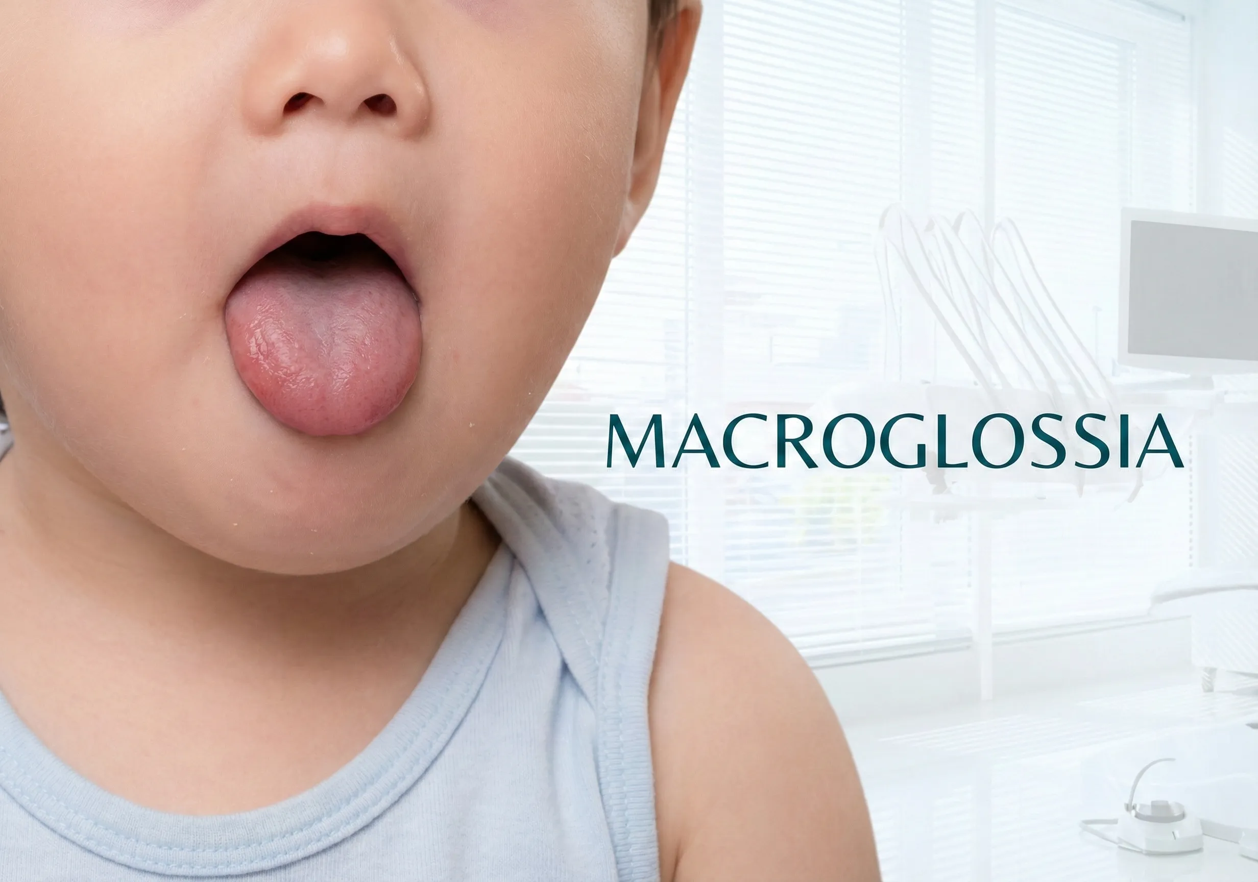 Macroglossia: Understanding an Enlarged Tongue and Its Impact on Oral Health