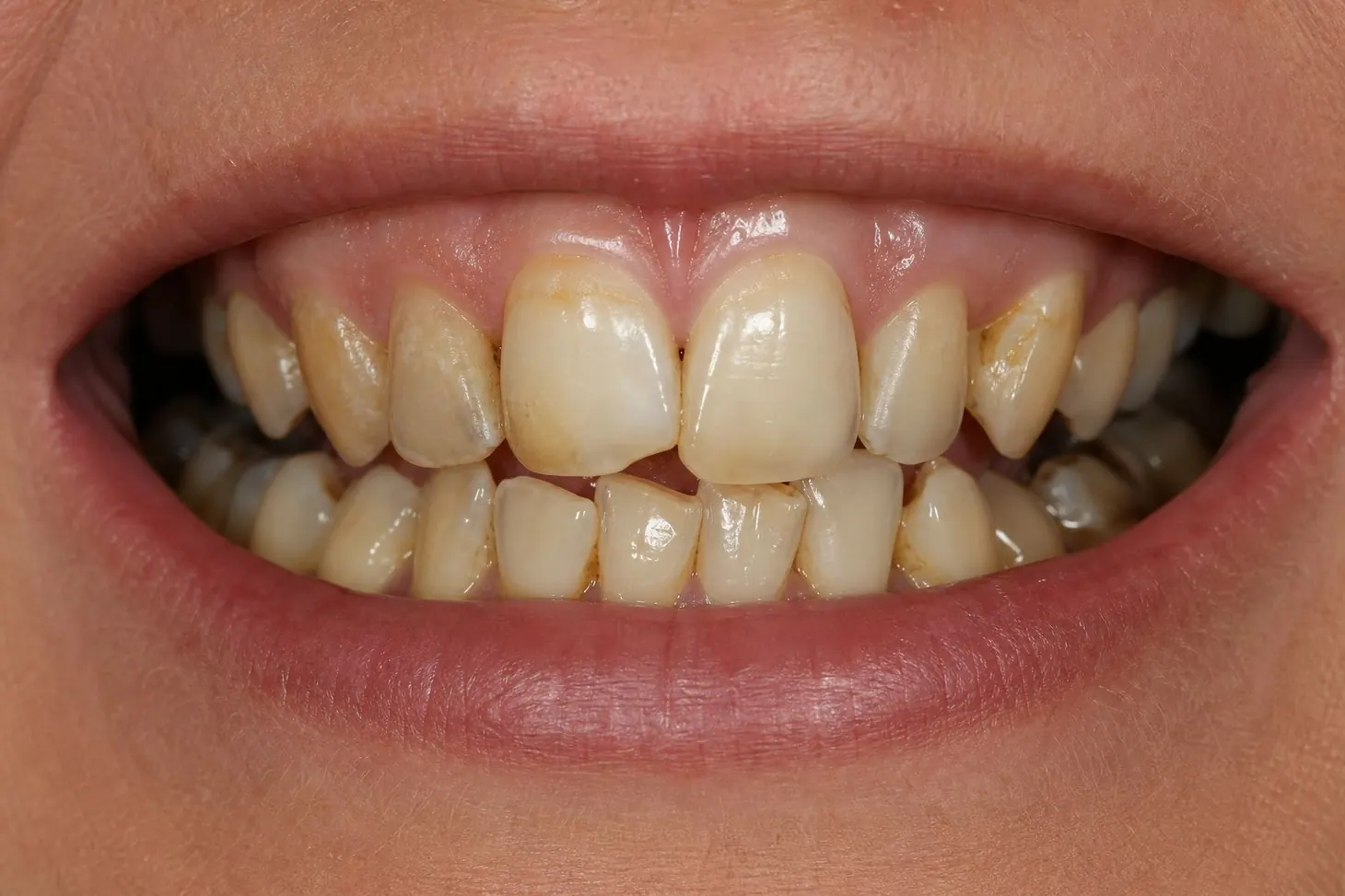 Full Smile Restoration — before treatment