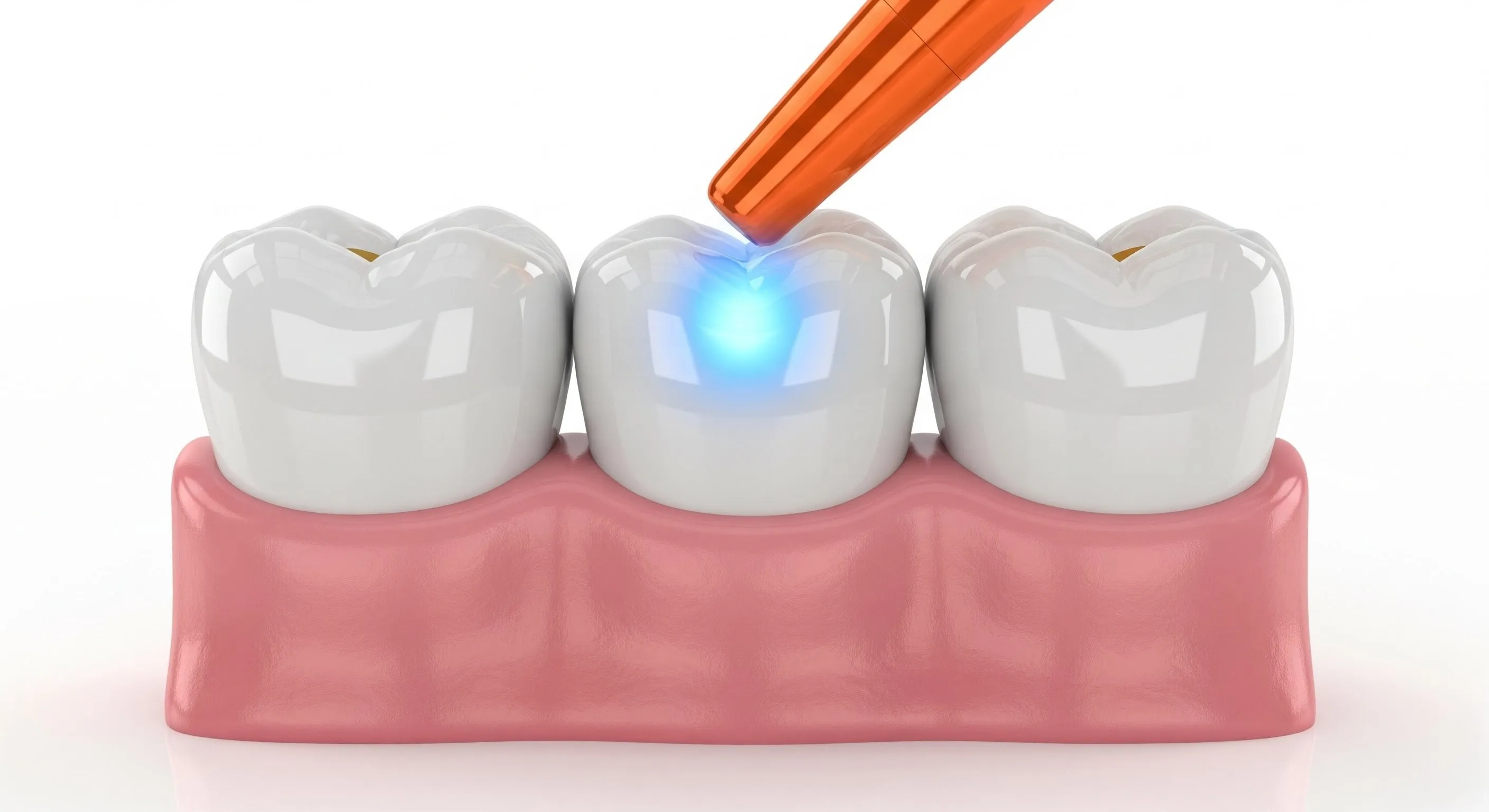 Composite Fillings Cost and Pricing Information in Bloomingdale