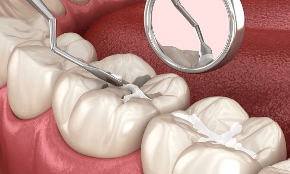 What Are Dental Sealants