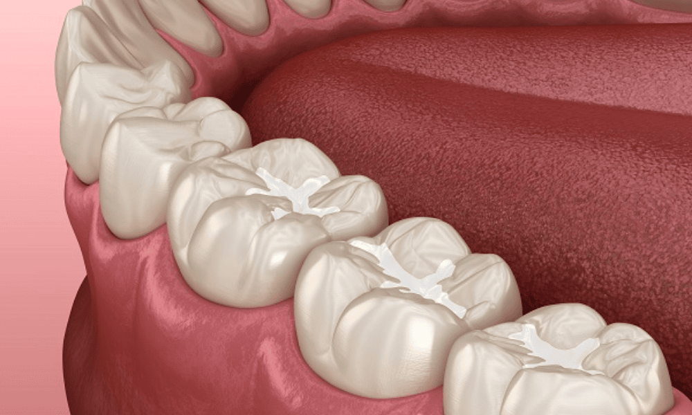 Benefits of Dental Sealants for Adults