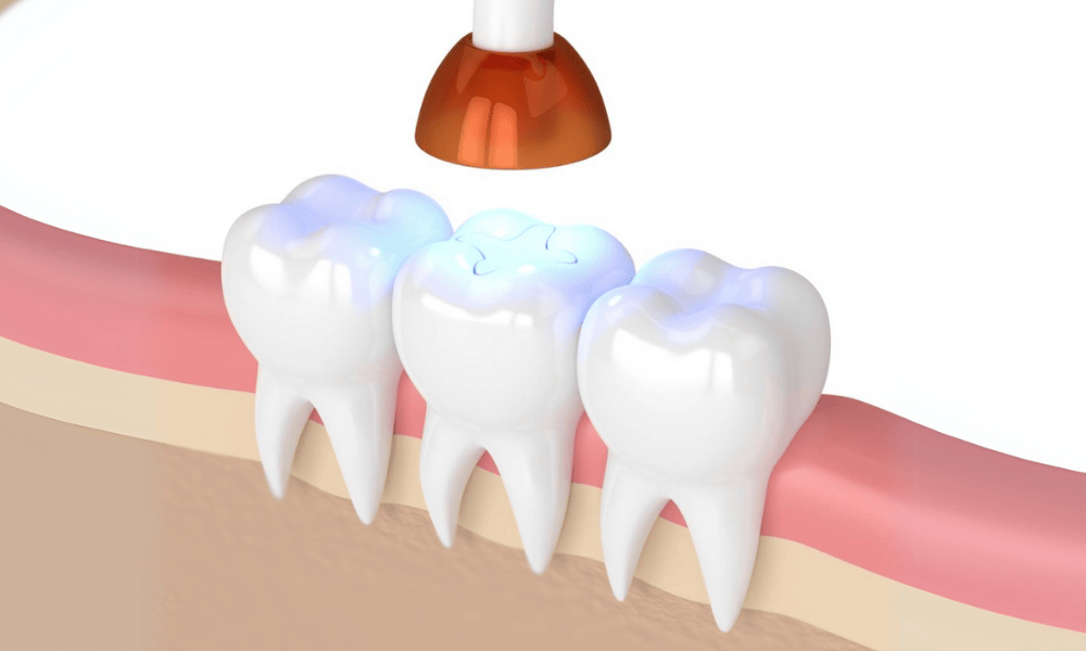 Composite Fillings Cost and Pricing Information in Bloomingdale